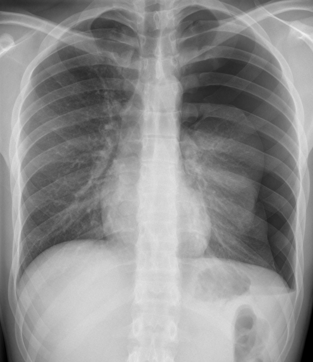 Röntgen-Thorax: Pneumothorax, fehlende Lungenzeichnung lateral